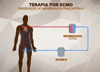 MC Marcinho usa terapia conhecida como ECMO, espécie de pulmão artificial; entenda como funciona MC Marcinho usa terapia conhecida como ECMO, espécie de pulmão artificial; entenda como funciona
