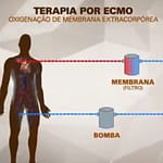 MC Marcinho usa terapia conhecida como ECMO, espécie de pulmão artificial; entenda como funciona MC Marcinho usa terapia conhecida como ECMO, espécie de pulmão artificial; entenda como funciona