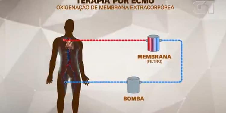 MC Marcinho usa terapia conhecida como ECMO, espécie de pulmão artificial; entenda como funciona
